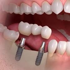 Implant supported bridge