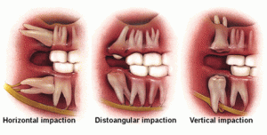 Wisdom Teeth Removal