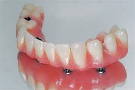 implant supported complete denture1