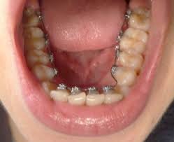 lingual braces2
