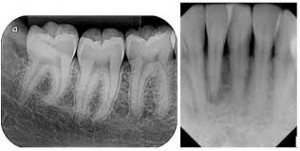 periapical xray