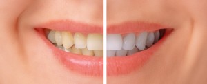 Teeth whitening procedure