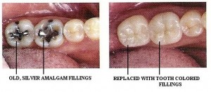 Tooth Coloured Fillings