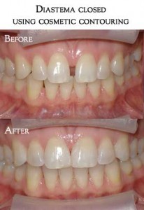 tooth contouring2