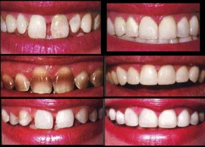 Dental Veneers